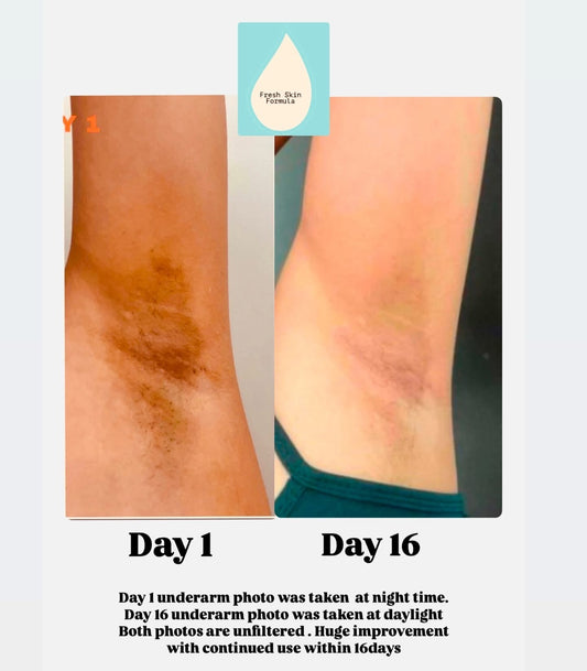 Underarm Whitening Power Set